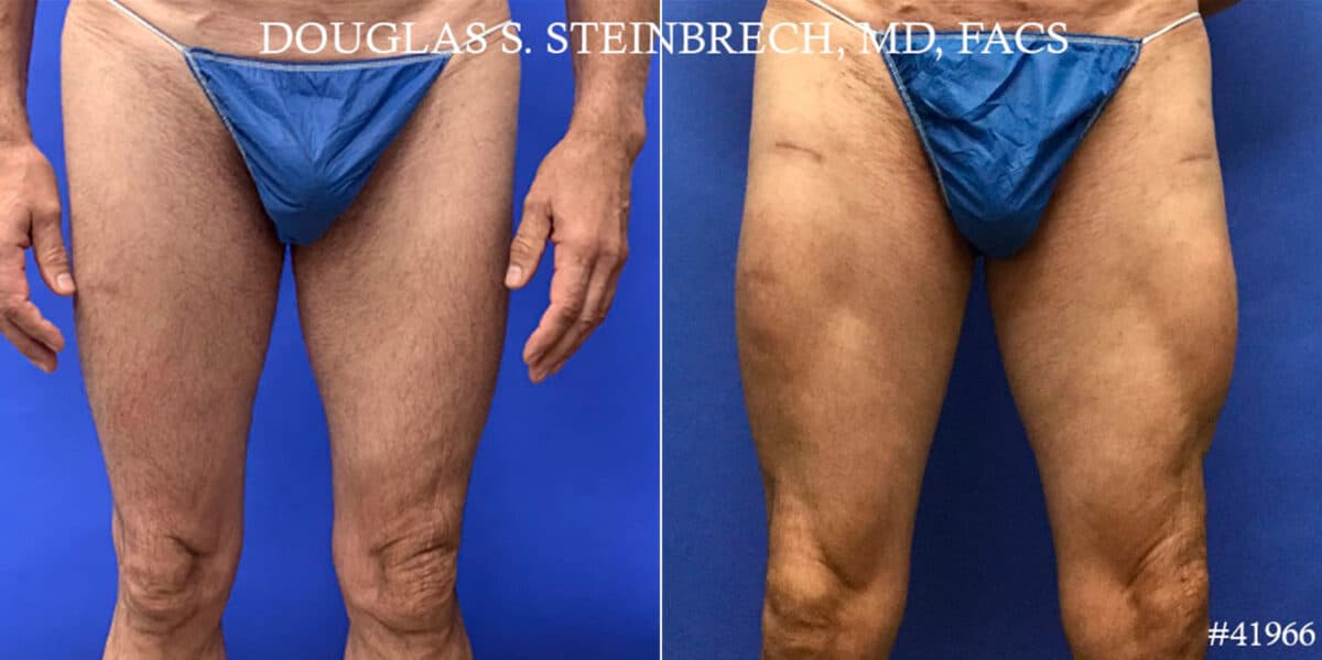 Calf Implants Before and After Photos in CA, Beverly Hills, Patient 18598