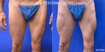 Calf Implants Before and After Photos in CA, Beverly Hills, Patient 18598