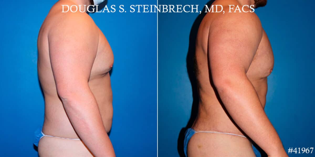Body Banking Before and After Photos in CA, Beverly Hills, Patient 18620