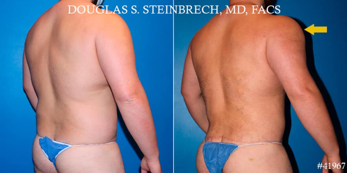 Body Banking Before and After Photos in CA, Beverly Hills, Patient 18620