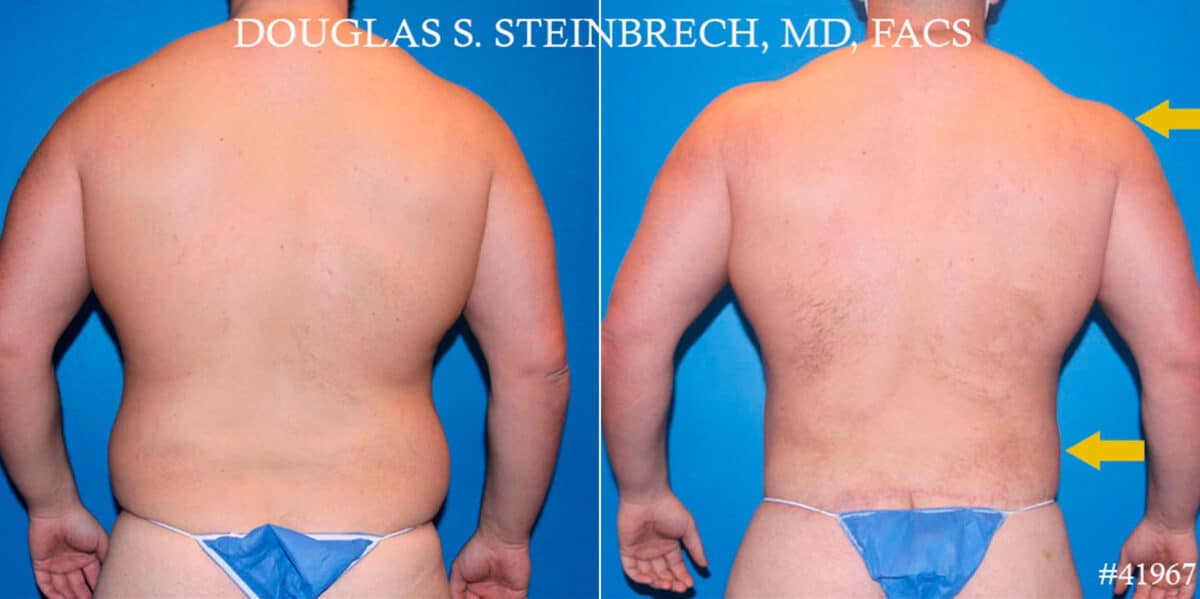 Body Banking Before and After Photos in CA, Beverly Hills, Patient 18620
