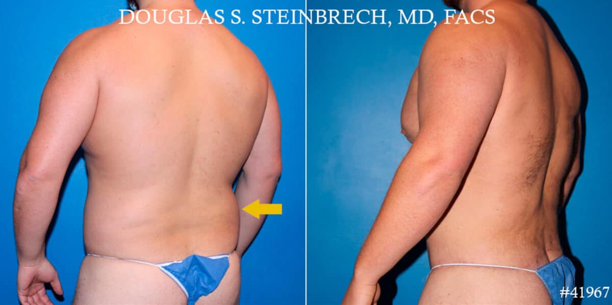 Body Banking Before and After Photos in CA, Beverly Hills, Patient 18620