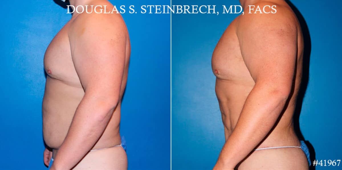 Body Banking Before and After Photos in CA, Beverly Hills, Patient 18620