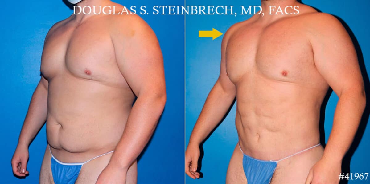 Body Banking Before and After Photos in CA, Beverly Hills, Patient 18620