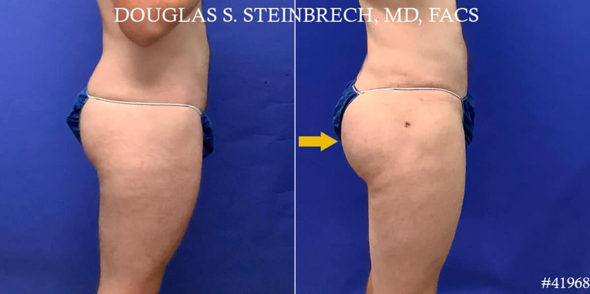 Body Banking Before and After Photos in CA, Beverly Hills, Patient 18633