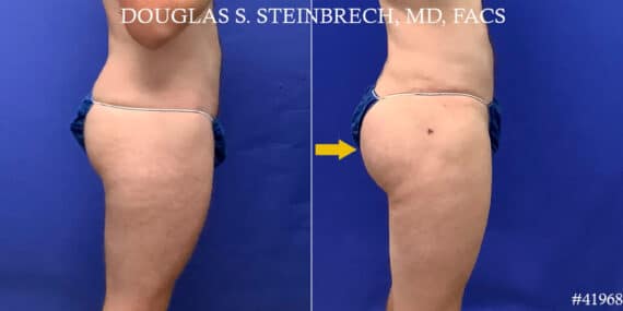 Body Banking Before and After Photos in CA, Beverly Hills, Patient 18633