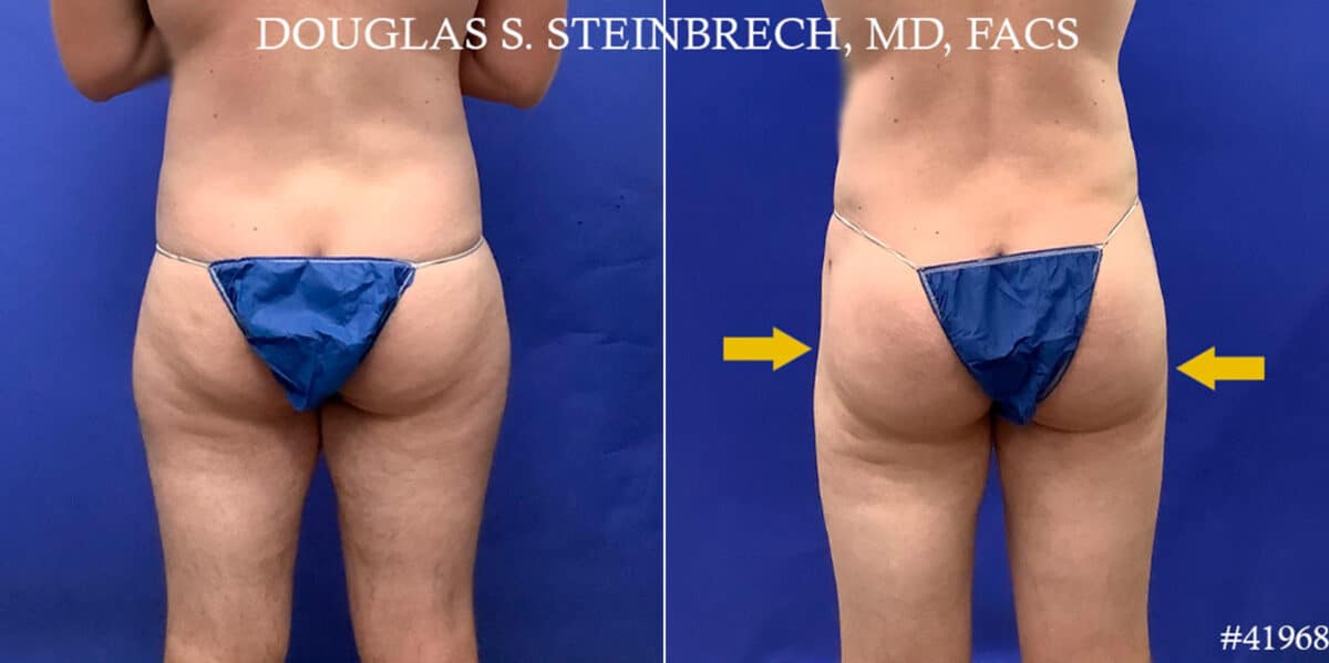 Body Banking Before and After Photos in CA, Beverly Hills, Patient 18633