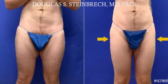 Body Banking Before and After Photos in CA, Beverly Hills, Patient 18633