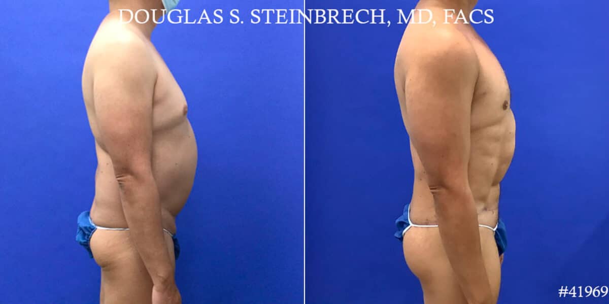 Body Banking Before and After Photos in CA, Beverly Hills, Patient 18643