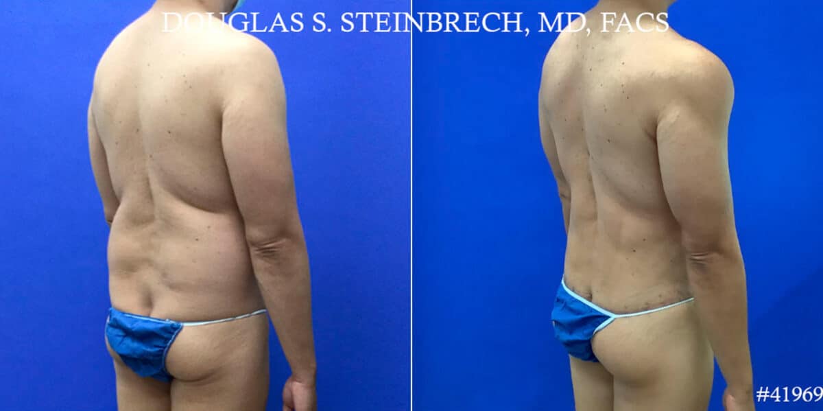 Body Banking Before and After Photos in CA, Beverly Hills, Patient 18643