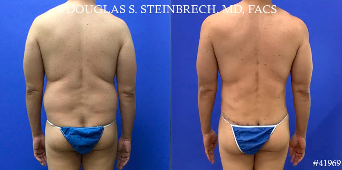 Body Banking Before and After Photos in CA, Beverly Hills, Patient 18643