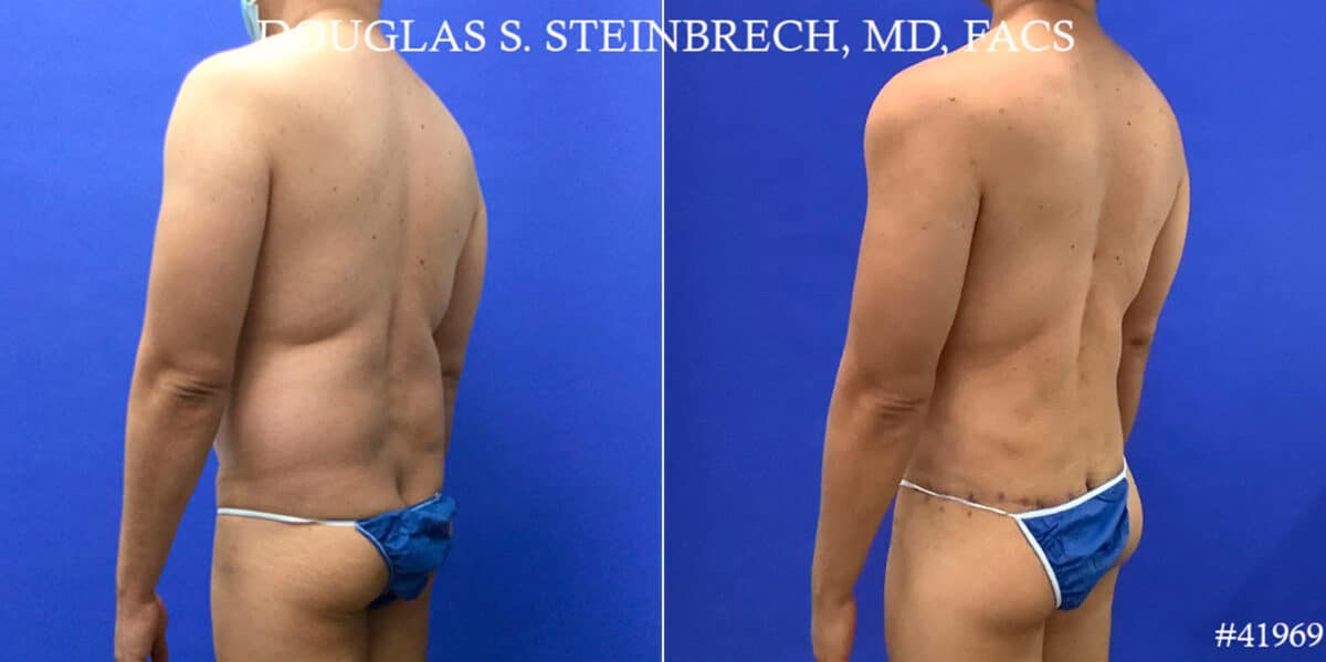 Body Banking Before and After Photos in CA, Beverly Hills, Patient 18643