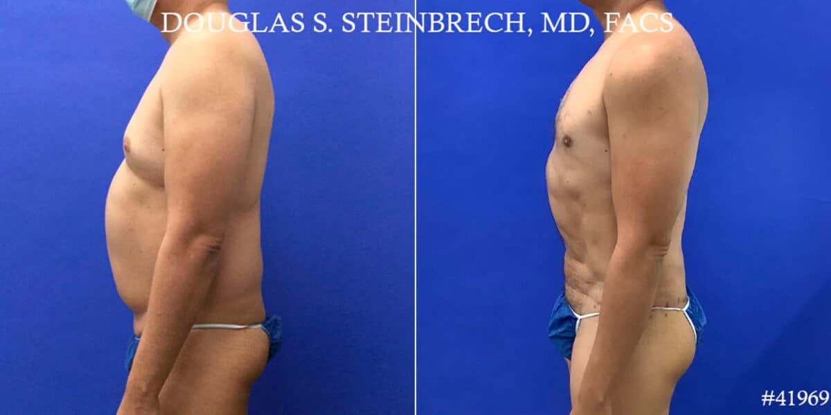 Body Banking Before and After Photos in CA, Beverly Hills, Patient 18643