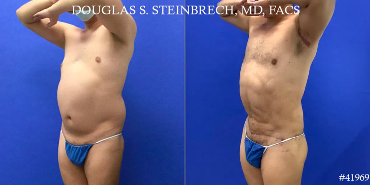 Body Banking Before and After Photos in CA, Beverly Hills, Patient 18643