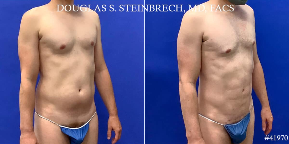 Body Banking Before and After Photos in CA, Beverly Hills, Patient 18668