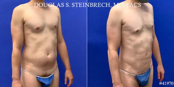 Body Banking Before and After Photos in CA, Beverly Hills, Patient 18668