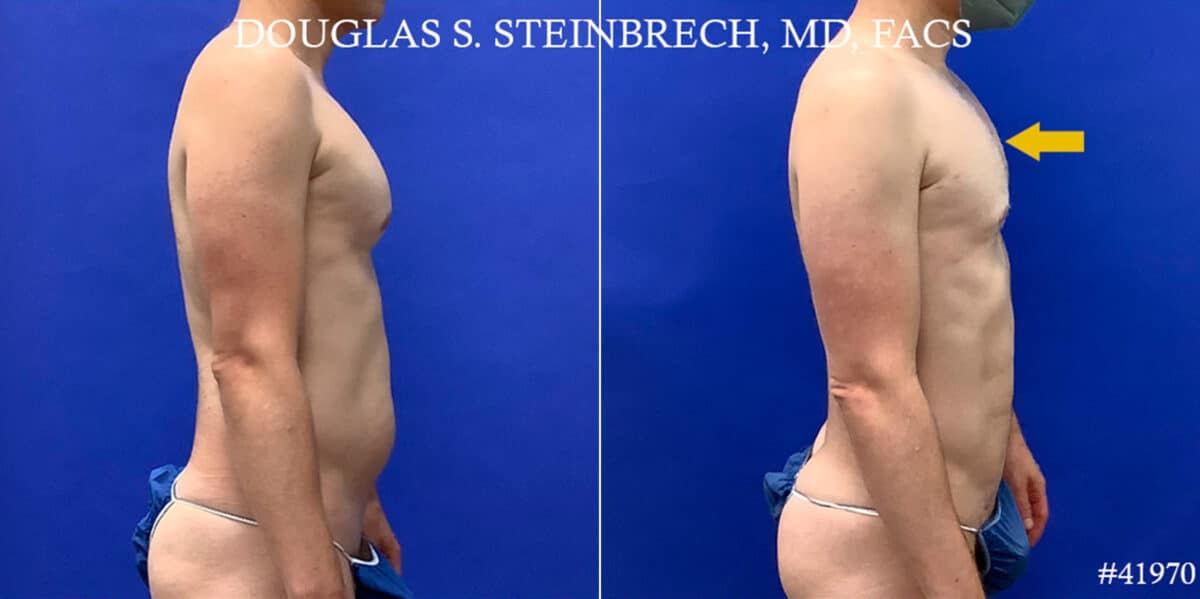 Body Banking Before and After Photos in CA, Beverly Hills, Patient 18668