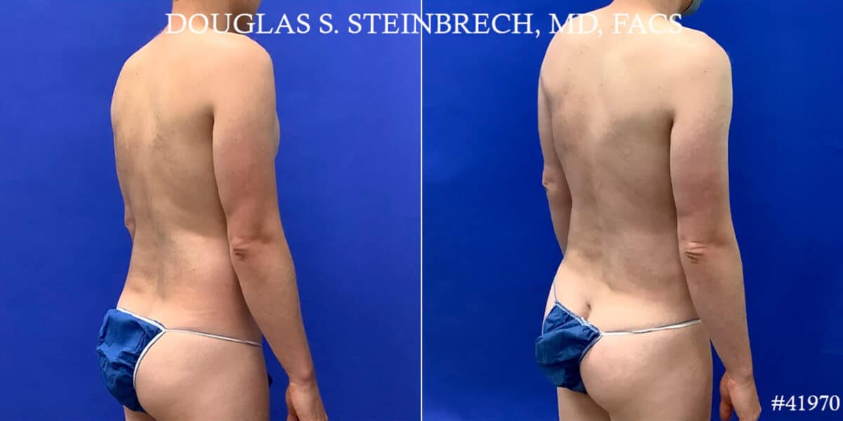 Body Banking Before and After Photos in CA, Beverly Hills, Patient 18668