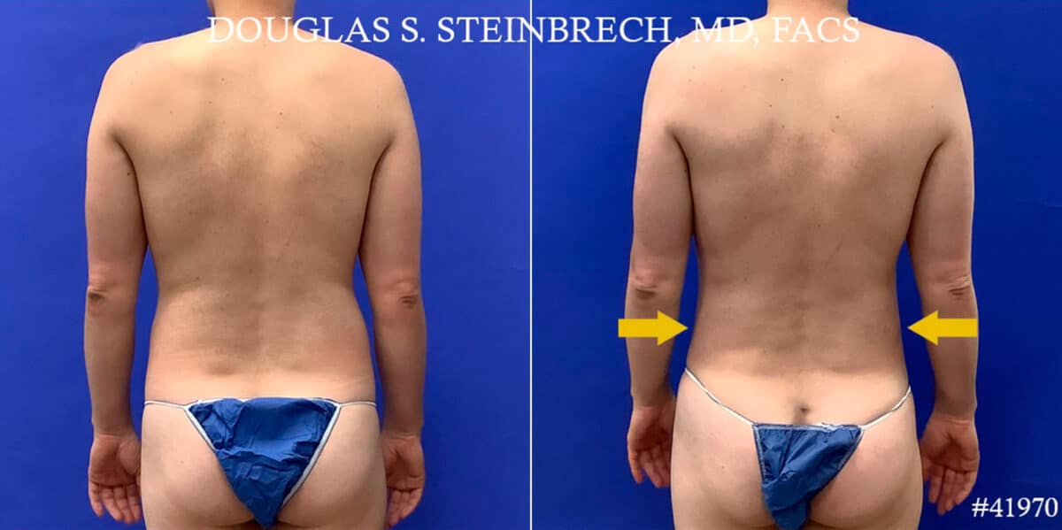 Body Banking Before and After Photos in CA, Beverly Hills, Patient 18668