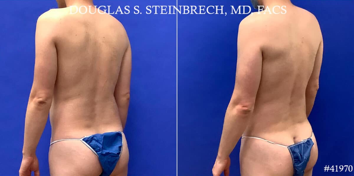 Body Banking Before and After Photos in CA, Beverly Hills, Patient 18668