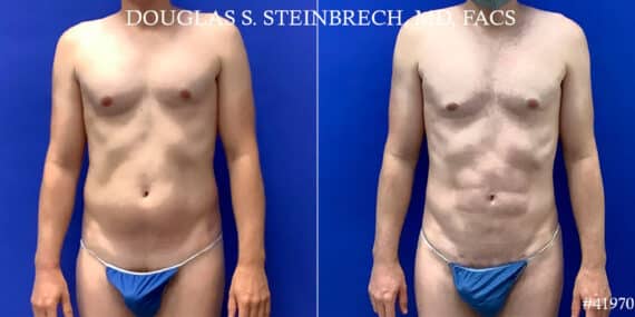 Body Banking Before and After Photos in CA, Beverly Hills, Patient 18668