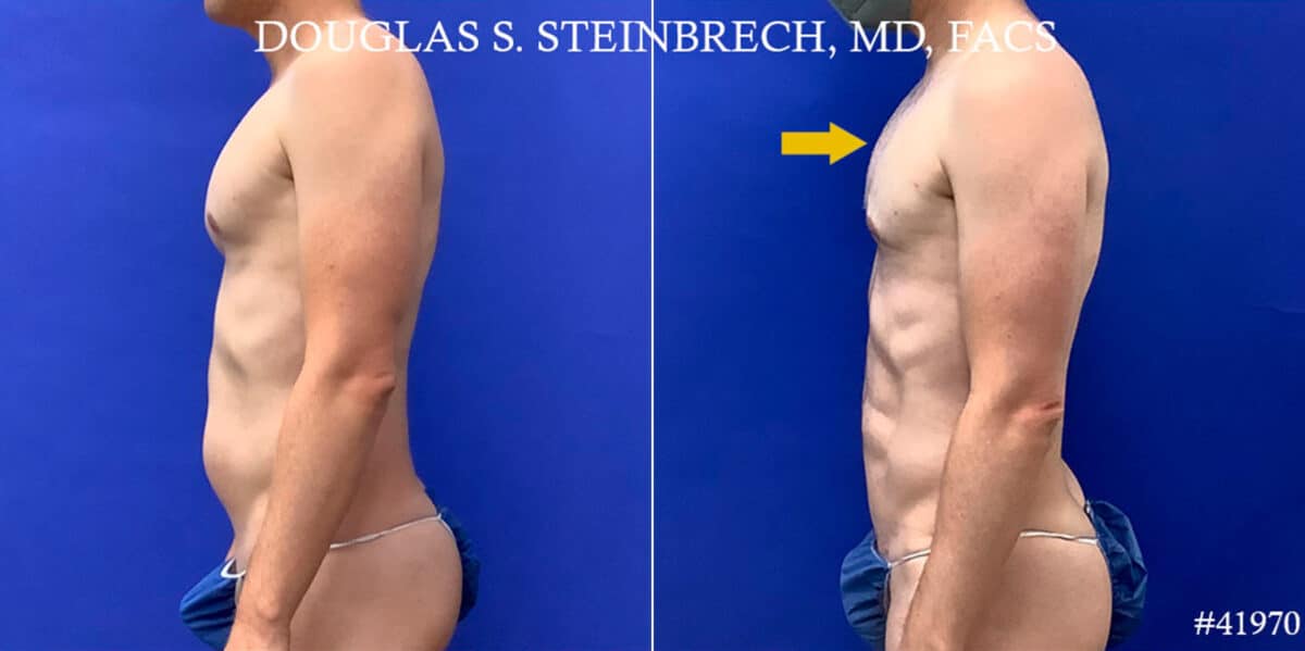 Body Banking Before and After Photos in CA, Beverly Hills, Patient 18668