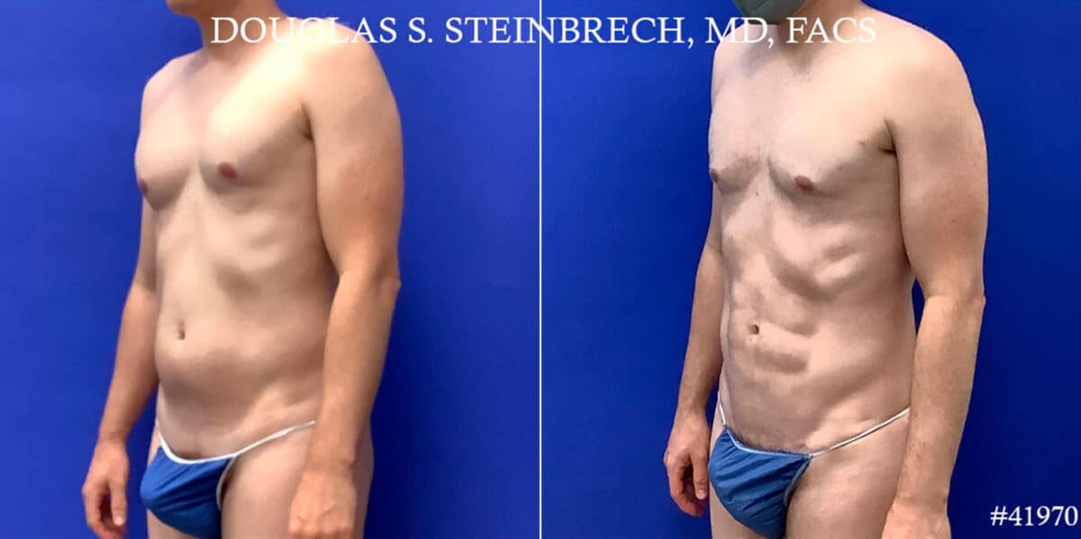 Body Banking Before and After Photos in CA, Beverly Hills, Patient 18668