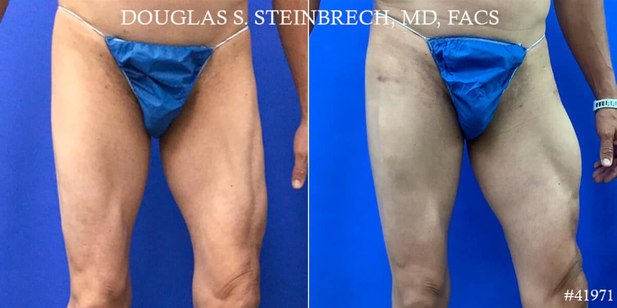 Calf Implants Before and After Photos in CA, Beverly Hills, Patient 18693