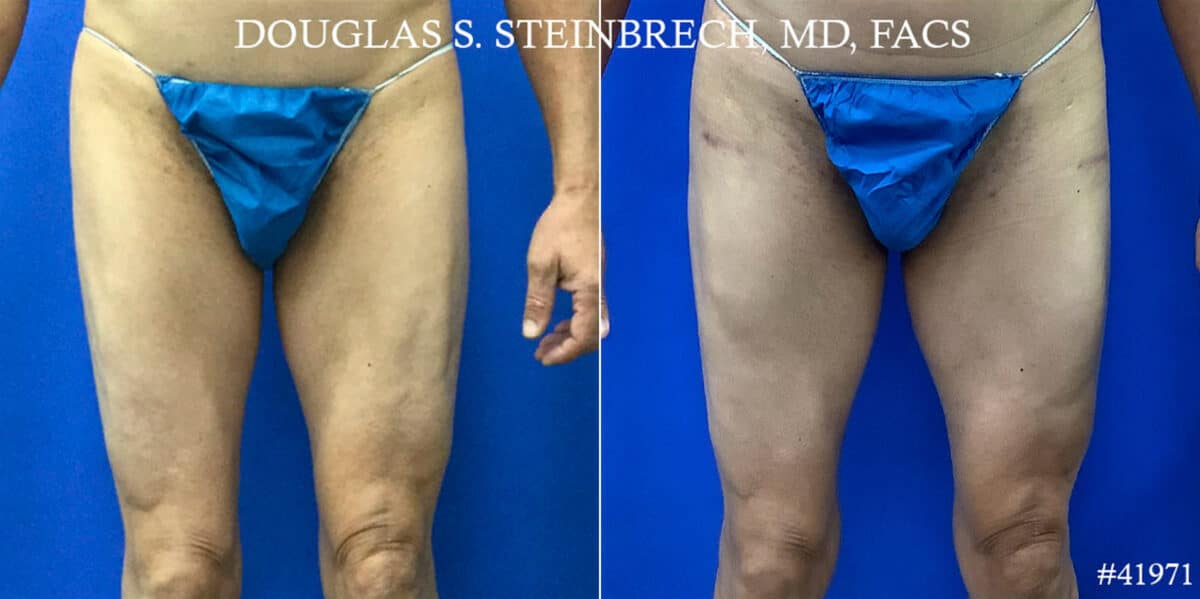 Calf Implants Before and After Photos in CA, Beverly Hills, Patient 18693