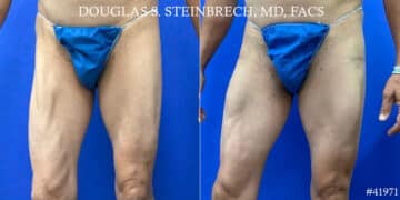 Calf Implants Before and After Photos in CA, Beverly Hills, Patient 18693