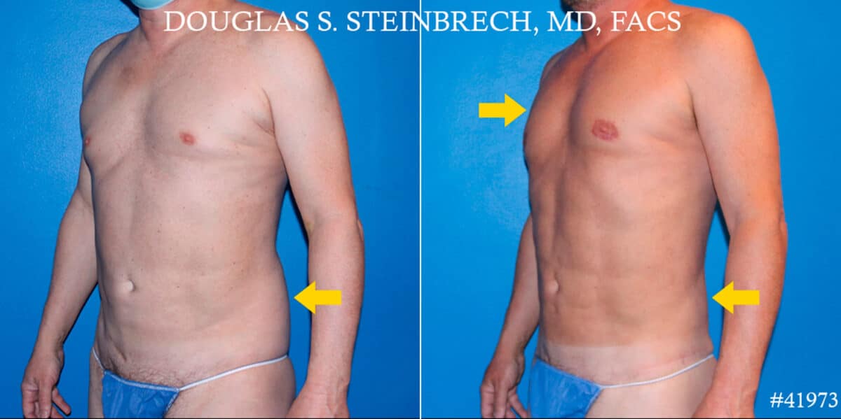Body Banking Before and After Photos in CA, Beverly Hills, Patient 19051