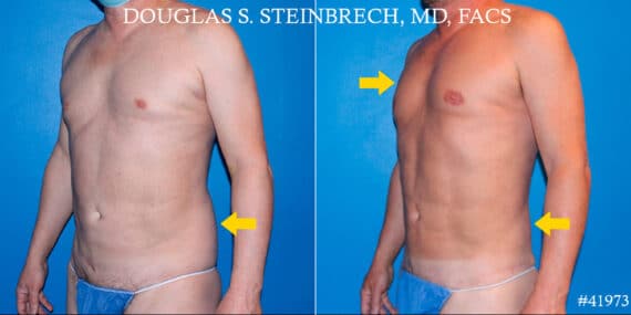 Body Banking Before and After Photos in CA, Beverly Hills, Patient 19051