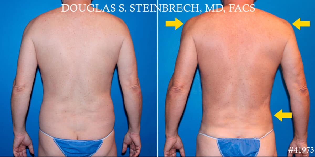 Body Banking Before and After Photos in CA, Beverly Hills, Patient 19051