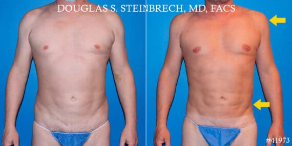 Body Banking Before and After Photos in CA, Beverly Hills, Patient 19051