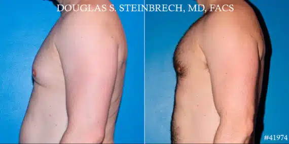 Pectoral Augmentation Before and After Photos in CA, Beverly Hills, Patient 19080