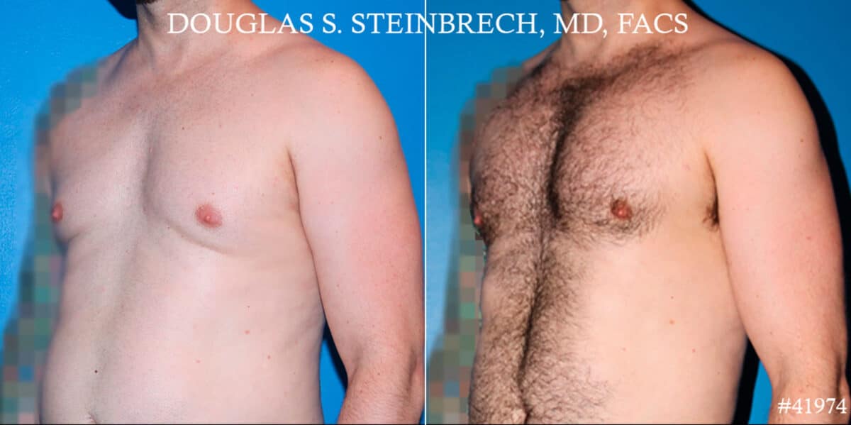 Pectoral Augmentation Before and After Photos in CA, Beverly Hills, Patient 19080