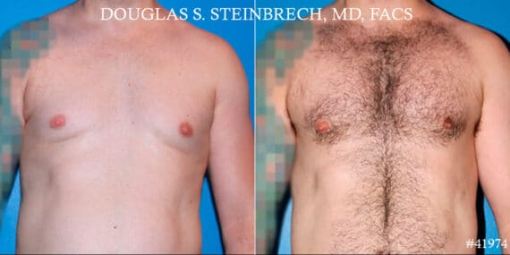 Pectoral Augmentation Before and After Photos in CA, Beverly Hills, Patient 19080