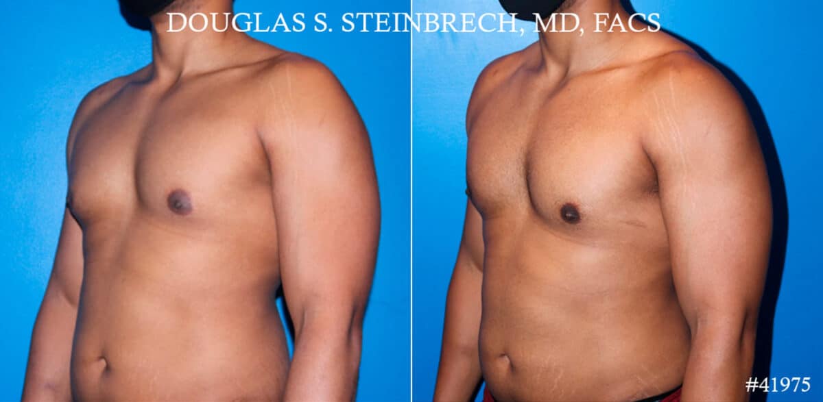 Gynecomastia Before and After Photos in CA, Beverly Hills, Patient 19084