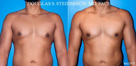 Gynecomastia Before and After Photos in CA, Beverly Hills, Patient 19084