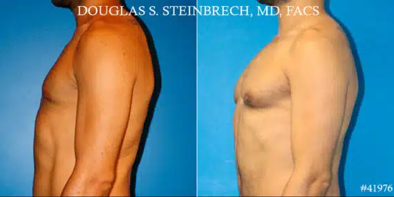 Pectoral Augmentation Before and After Photos in CA, Beverly Hills, Patient 19088