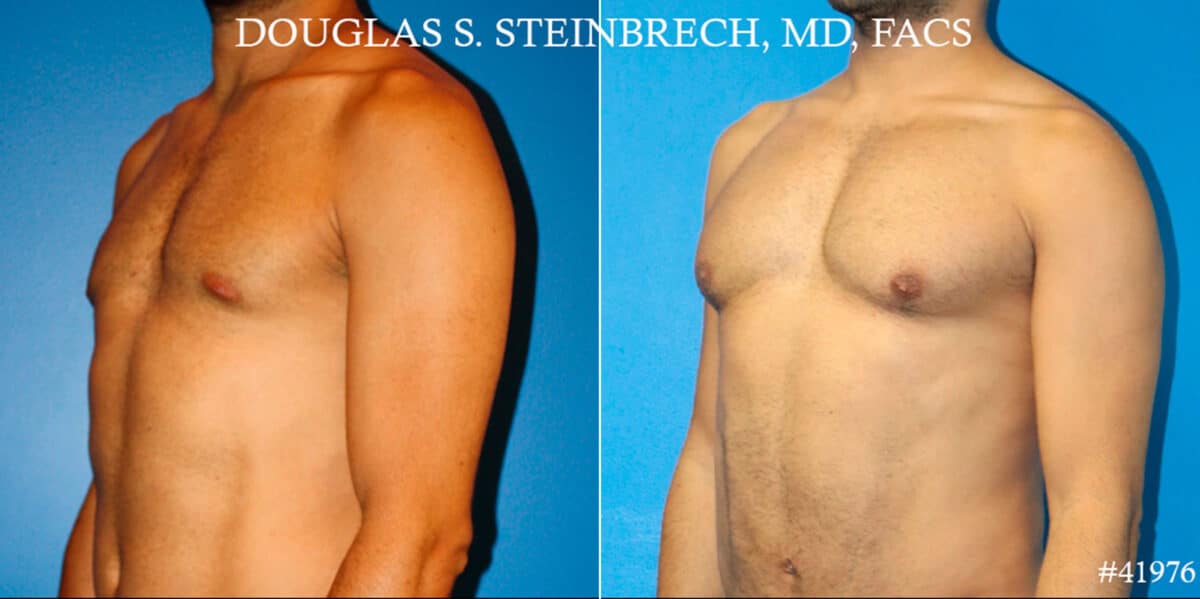 Pectoral Augmentation Before and After Photos in CA, Beverly Hills, Patient 19088