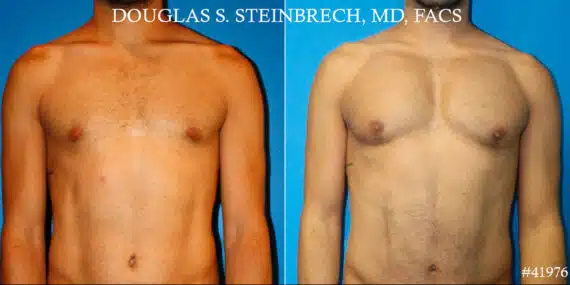 Pectoral Augmentation Before and After Photos in CA, Beverly Hills, Patient 19088