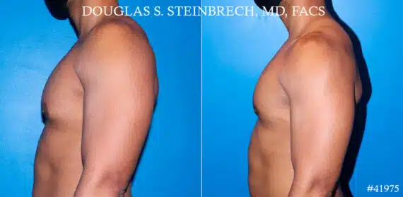 Gynecomastia Before and After Photos in CA, Beverly Hills, Patient 19084