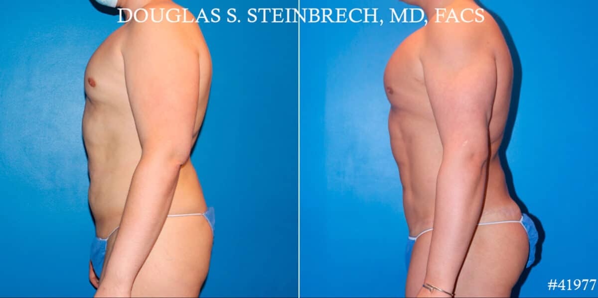 Body Banking Before and After Photos in CA, Beverly Hills, Patient 19119