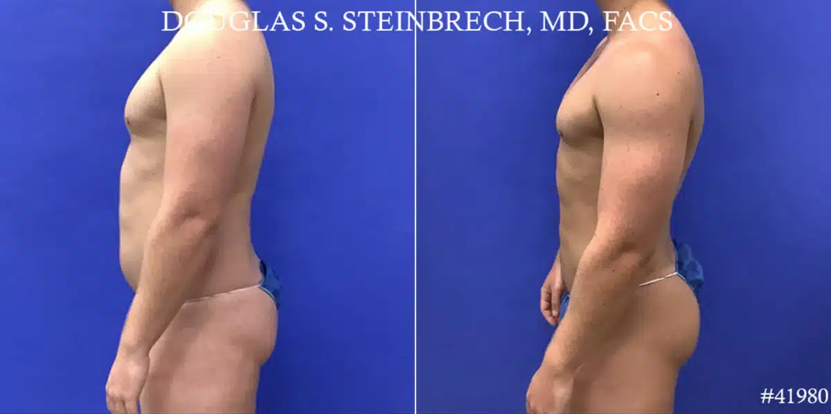 Body Banking Before and After Photos in CA, Beverly Hills, Patient 19143