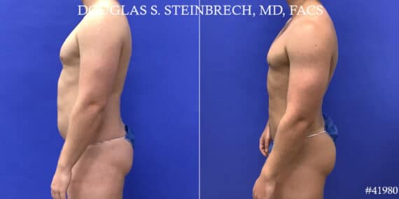 Body Banking Before and After Photos in CA, Beverly Hills, Patient 19143
