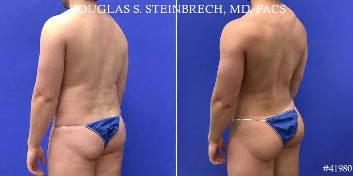 Body Banking Before and After Photos in CA, Beverly Hills, Patient 19143
