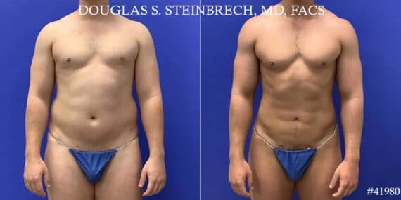 Body Banking Before and After Photos in CA, Beverly Hills, Patient 19143