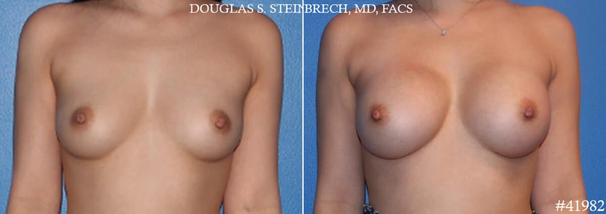 Breast Augmentation Before and After Photos in CA, Beverly Hills, Patient 19156