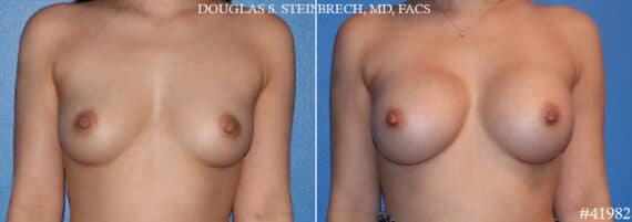 Breast Augmentation Before and After Photos in CA, Beverly Hills, Patient 19156